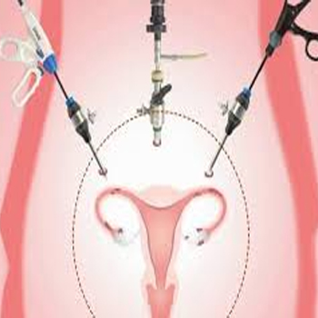 Total Laparoscopic Hysterectomy Treatment In Ghaziabad